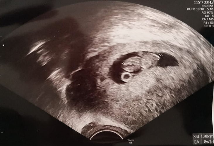 ultraschall 9 ssw junge1