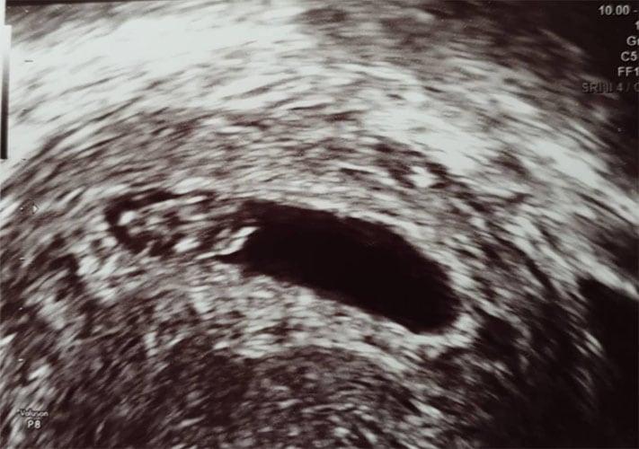 ultraschall 9 ssw junge2
